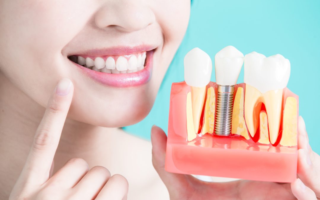 ¿Qué pasos hay que seguir para colocar un implante dental?
