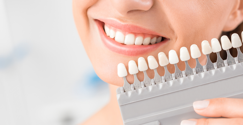 Carillas dentales vs. coronas dentales: ¿Cuál es la mejor opción para ti?